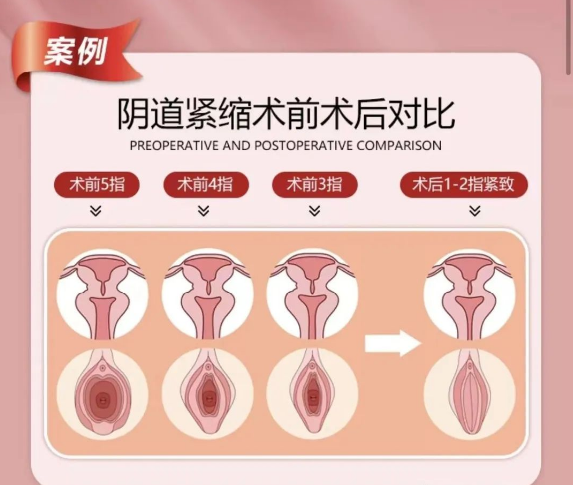 阴道松弛自测.png