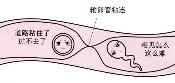 输卵管粘连.png