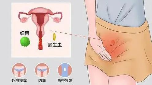 婦科炎症.jpg